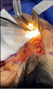 extraction--hidroxibenceno-face